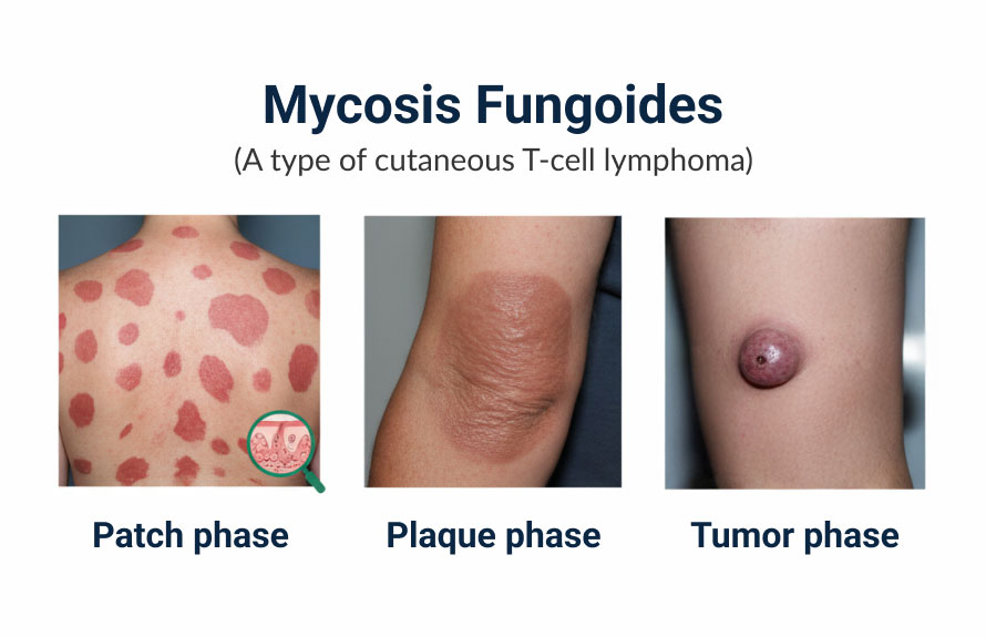 Mycosis Fungoides
